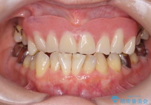 金属床義歯・PGA(ゴールド)クラウン　合わない入れ歯の新製　の治療前