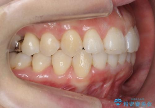30代女性　インビザラインで前歯をキレイに　マウスピース矯正の治療後