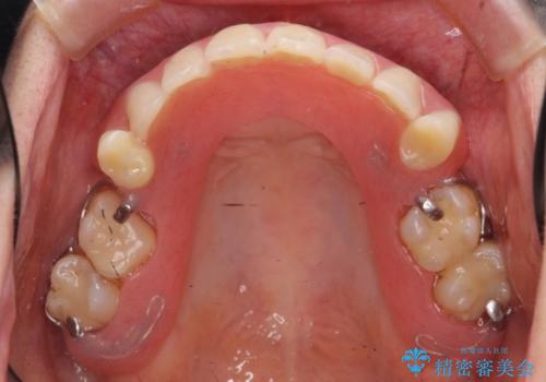 金属床義歯・PGA(ゴールド)クラウン　合わない入れ歯の新製　の症例 治療前