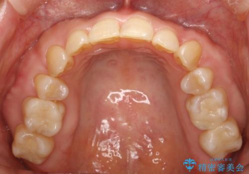 全顎矯正+セラミック治療による口腔内の総合リコンストラクションの症例 治療後