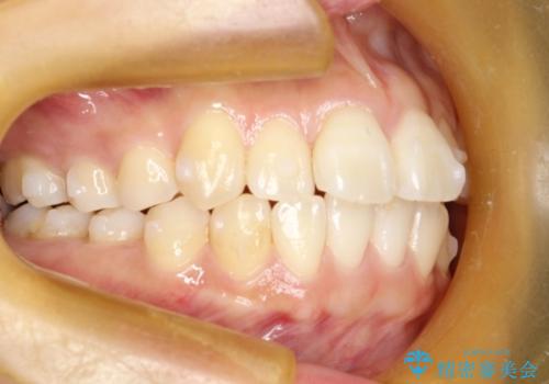 インビザライン治療　ガタつきの改善と一緒に、なるべく前歯を下げたいの治療中