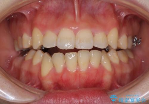 前歯がガタガタで食べ物が咬み切れない　フルリンガルによる裏側矯正の治療中