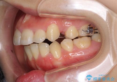 前歯がガタガタで食べ物が咬み切れない　フルリンガルによる裏側矯正の治療中