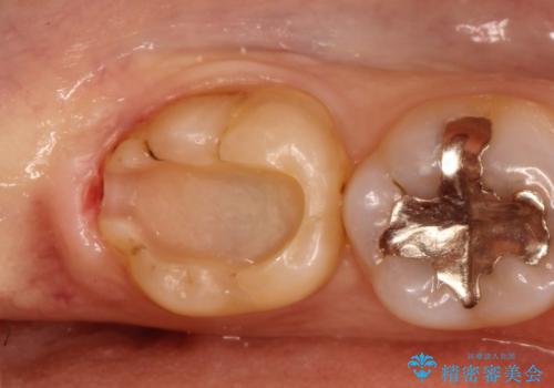 銀歯の内側で虫歯が再発　セラミックインレー修復で再発しないようにの治療中