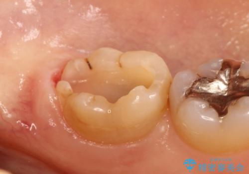 銀歯の内側で虫歯が再発　セラミックインレー修復で再発しないようにの治療中