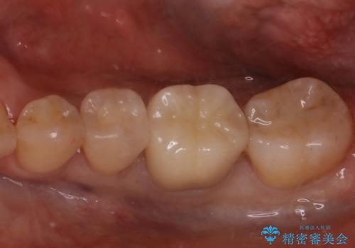 保険の被せ物を綺麗なセラミックに