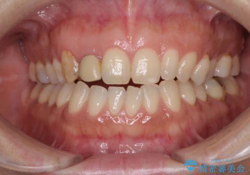 前歯の歯並びと小さい歯を改善　インビザラインとオールセラミッククラウンの症例 治療前