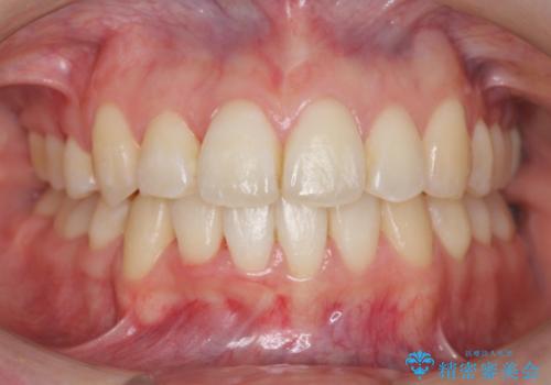 右だけ八重歯　最少限の抜歯の治療後