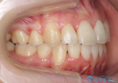 右だけ八重歯　最少限の抜歯の治療後