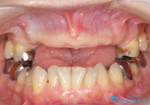 金属床義歯・PGA(ゴールド)クラウン　合わない入れ歯の新製　の治療中