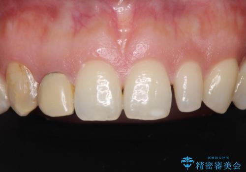 前歯の歯並びと小さい歯を改善　インビザラインとオールセラミッククラウンの治療中