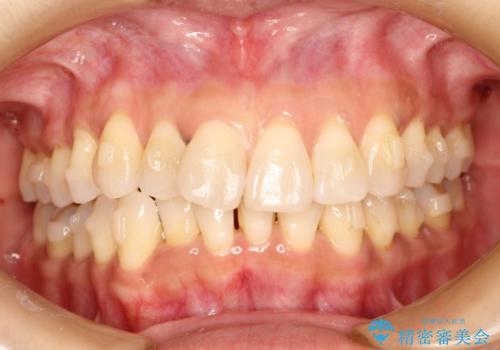 インビザラインによるかみ合わせの治療　奥歯の位置関係を是正してガタつきを治すの治療中