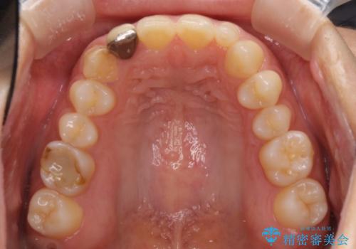 前歯の歯並びと小さい歯を改善　インビザラインとオールセラミッククラウンの治療前