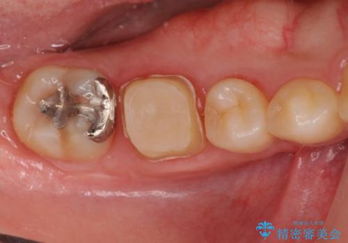 歯の高さがなく、被せ物が外れる　歯周外科手術で解決の治療前