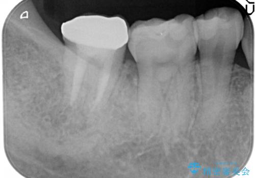 治療してもすぐに外れる歯。歯周外科後に、セラミッククラウンで解決!の治療後