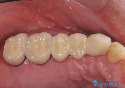 多発した縁下カリエス　歯周外科を併用する虫歯治療の治療後