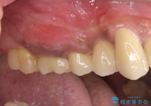 著しく腫れた歯ぐき　歯肉と歯の改善を行う歯周外科の症例 治療後