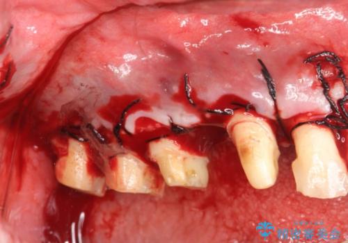 多発した縁下カリエス　歯周外科を併用する虫歯治療の治療中