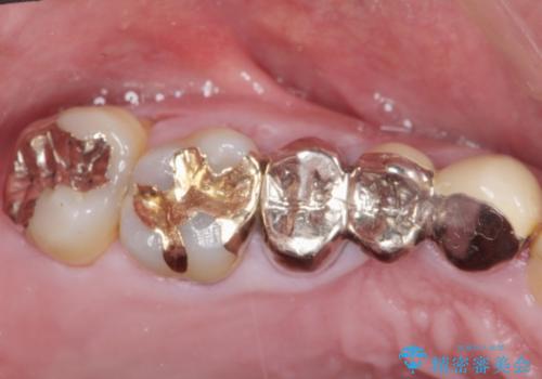 多発した縁下カリエス　歯周外科を併用する虫歯治療の治療前
