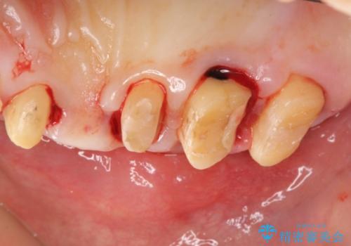 多発した縁下カリエス　歯周外科を併用する虫歯治療