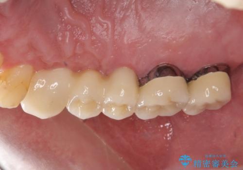 多発した縁下カリエス　歯周外科を併用する虫歯治療の治療後