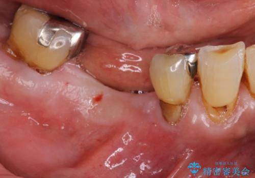小矯正を伴う臼歯部インプラント補綴の治療前