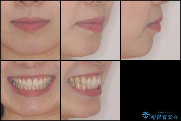 前歯のデコボコと出っ歯を治したい　インビザラインによる非抜歯矯正治療の治療後（顔貌）