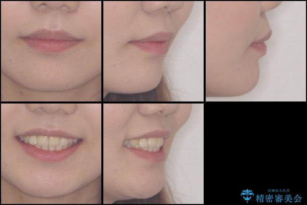 前歯の出っ歯とでこぼこ　目立たないワイヤーで抜歯矯正の治療後（顔貌）