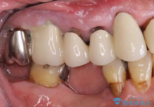 小矯正を伴う臼歯部インプラント補綴の治療前