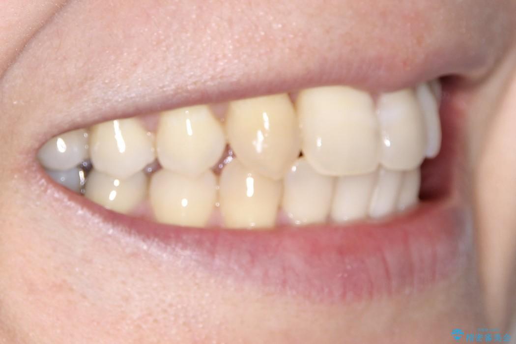 重度歯周炎の歯を抜歯してワイヤー矯正を　変則的なかみ合わせで仕上げるの治療後（顔貌）