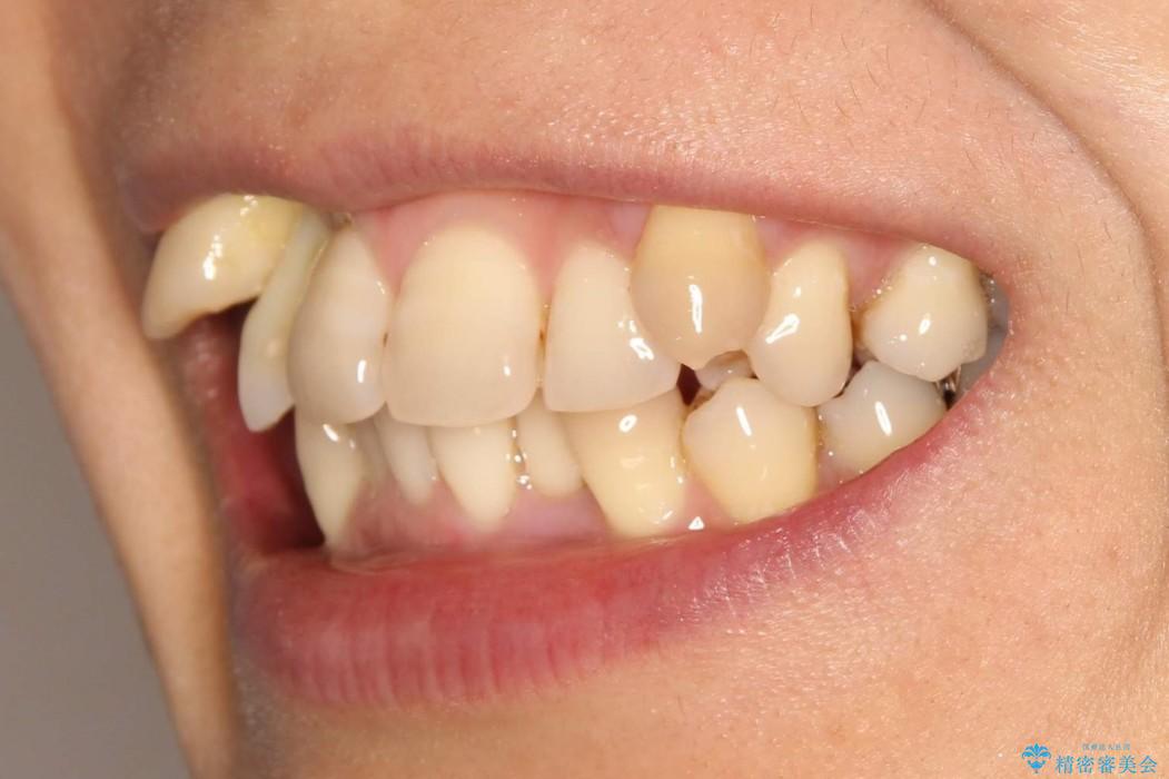 重度歯周炎の歯を抜歯してワイヤー矯正を　変則的なかみ合わせで仕上げるの治療前（顔貌）