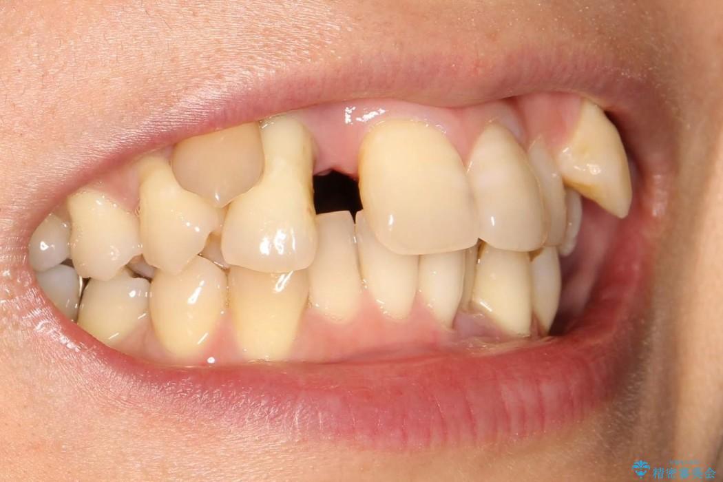 重度歯周炎の歯を抜歯してワイヤー矯正を　変則的なかみ合わせで仕上げるの治療前（顔貌）
