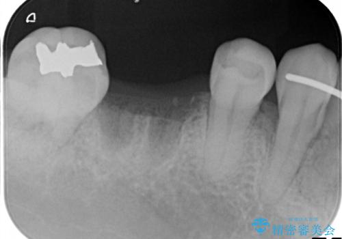 しっかり噛める奥歯。インプラント治療の治療前