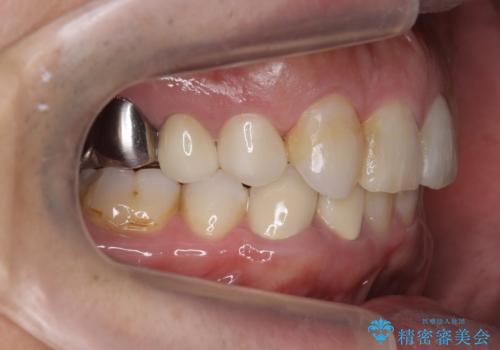 40代男性　総合歯科治療　矯正治療+虫歯治療の治療後
