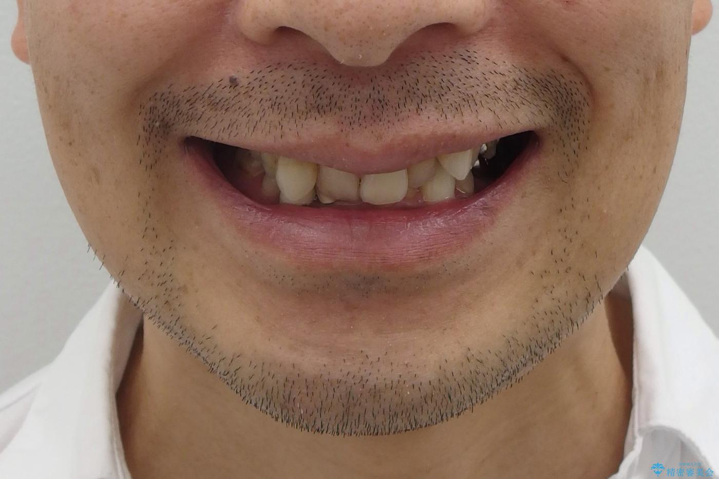 40代男性　総合歯科治療　矯正治療+虫歯治療の治療前（顔貌）