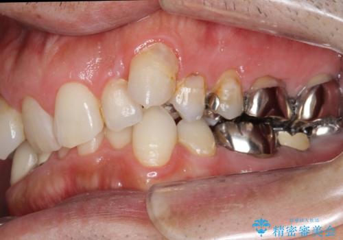 40代男性　総合歯科治療　矯正治療+虫歯治療の治療前