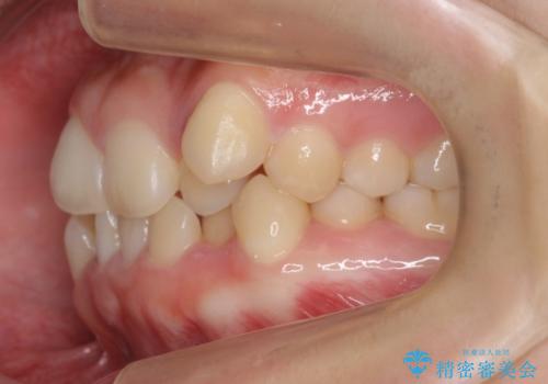 八重歯　奥歯のすれ違い　ワイヤー矯正でしっかり治療の治療前