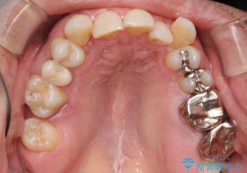 40代男性　総合歯科治療　矯正治療+虫歯治療の治療前