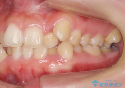 八重歯　奥歯のすれ違い　ワイヤー矯正でしっかり治療の治療前