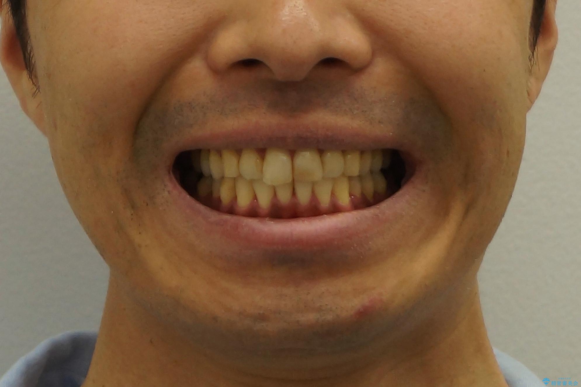 30代男性　歯を抜かないインビザライン　前歯のがたつきの治療の治療後（顔貌）