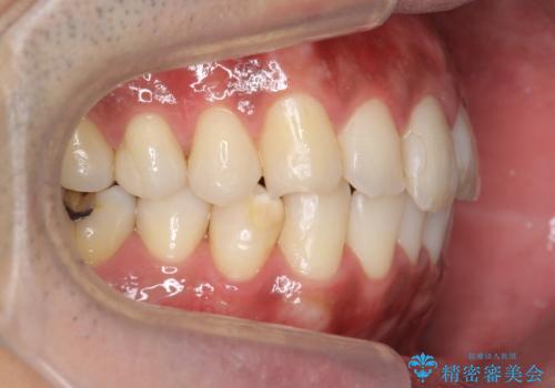 30代男性　歯を抜かないインビザライン　前歯のがたつきの治療の治療後