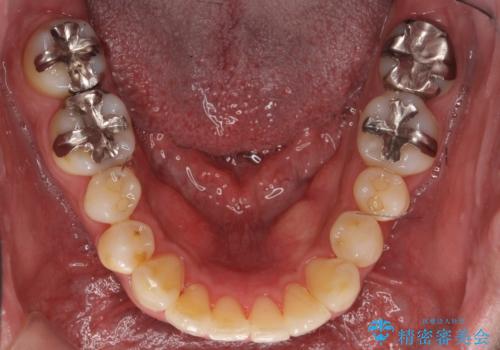 30代男性　歯を抜かないインビザライン　前歯のがたつきの治療の治療後