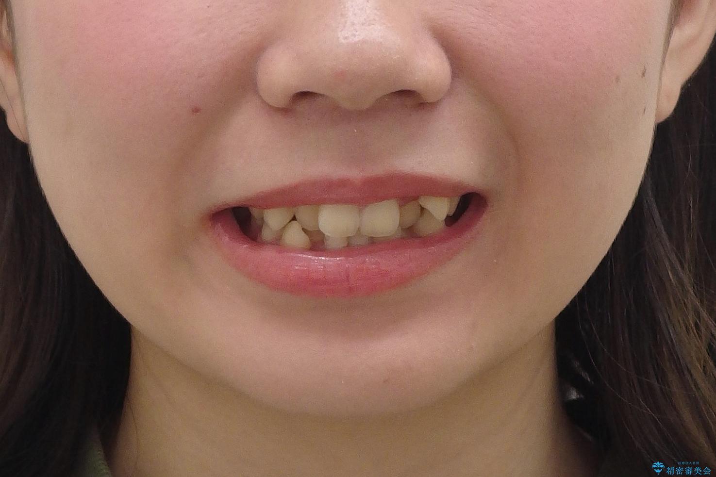 八重歯　奥歯のすれ違い　ワイヤー矯正でしっかり治療の治療前（顔貌）