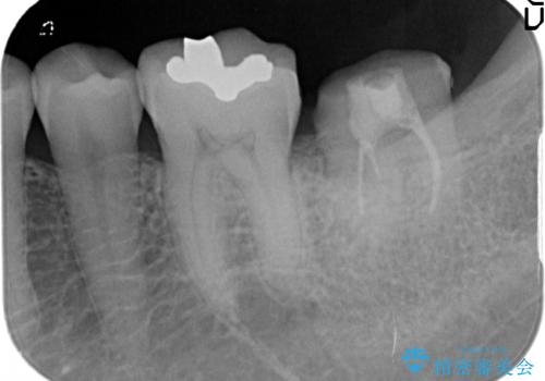 他院で仮歯が壊れまくる　高さの無い歯のゴールドクラウンの治療前