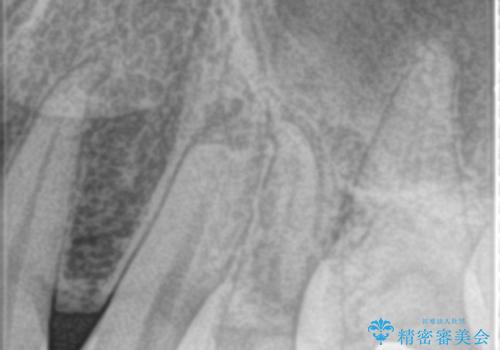 歯の神経の壊死による炎症への対応:湾曲根管を持つ左上4番の治療前