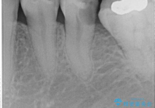 深い虫歯での神経を残す治療:左下5番への生活歯髄療法の治療前