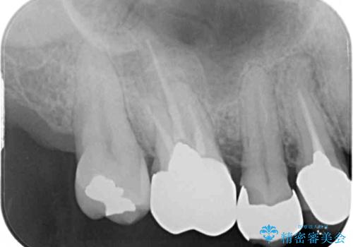 抜けたまま放置した奥歯　部分矯正やインプラントを用いた咬合回復の治療前