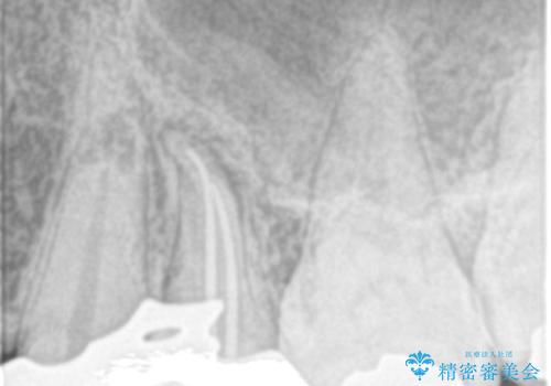 歯の神経の壊死による炎症への対応:湾曲根管を持つ左上4番の治療中