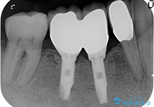 小矯正を伴う臼歯部インプラント補綴の治療後