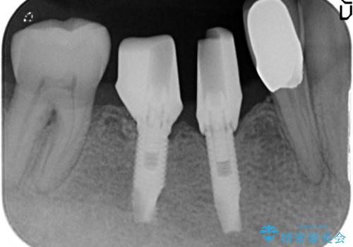小矯正を伴う臼歯部インプラント補綴の治療中
